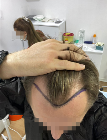 לפני השתלת שיער בקליניקה בלתי חוקית