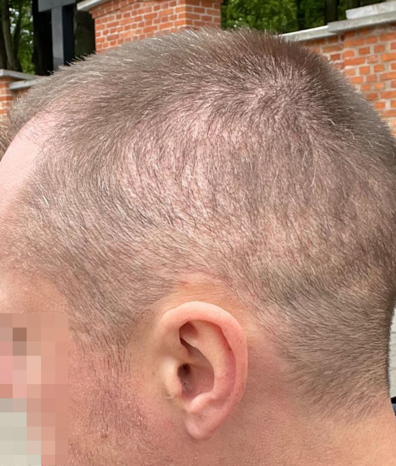 איזור תורם שקוצר יתר על המידה השתלת שיער