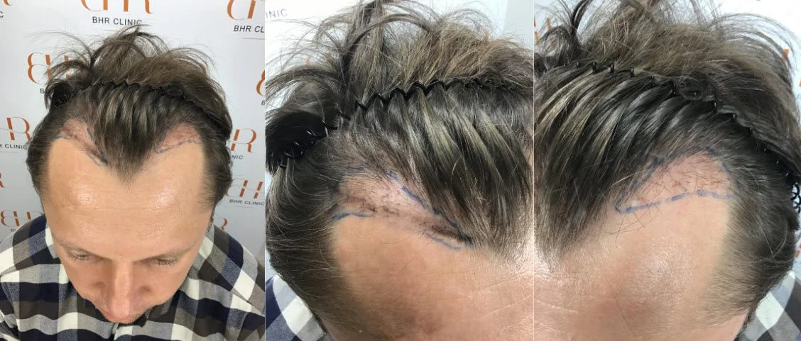 بعد 14 شهرًا من إصلاح زراعة الشعر
