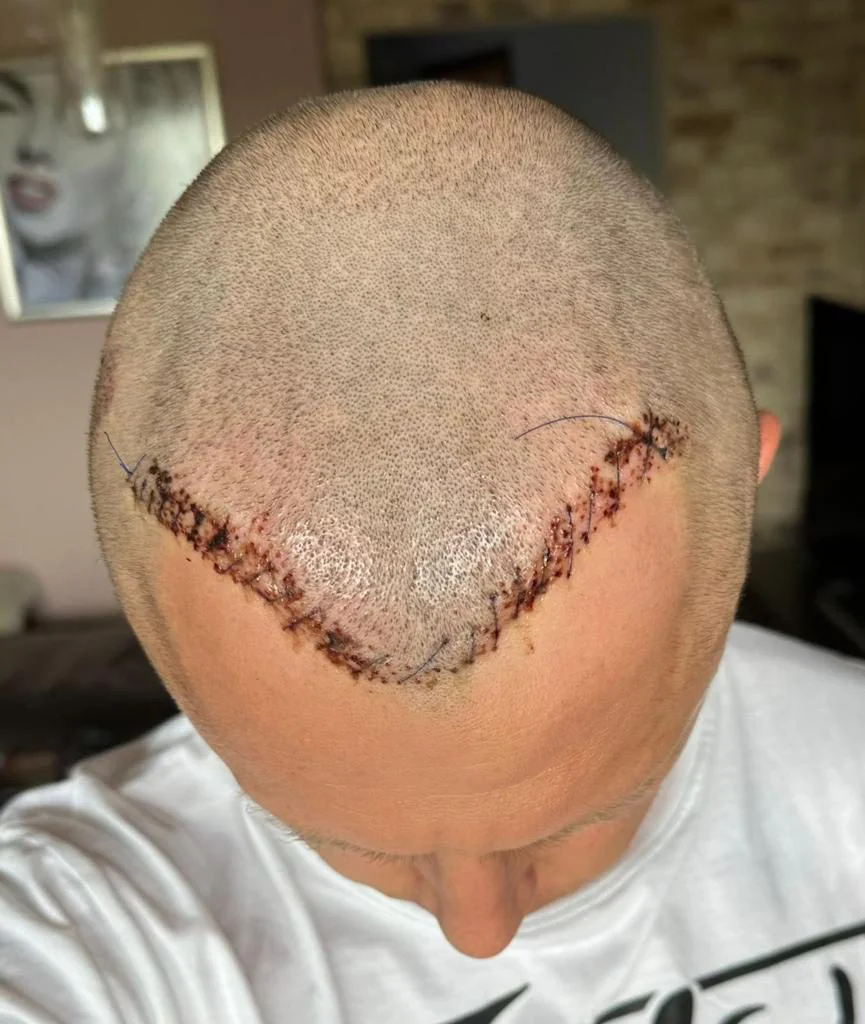 بعد إصلاح زراعة الشعر